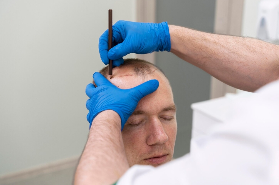 Bloom Hair Transplant